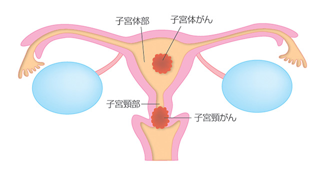 子宮がんのイラスト